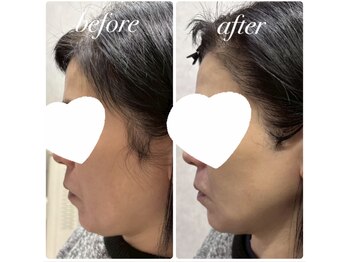 ニコサロン(25salon)/たるみにアプローチ