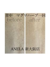 アネラ(ANELA)/エルモサハーブ症例背中