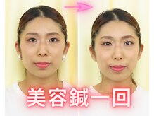 アイワ鍼灸整骨院/美容鍼ビフォーアフター
