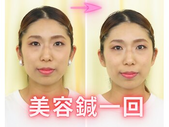 アイワ鍼灸整骨院/美容鍼ビフォーアフター