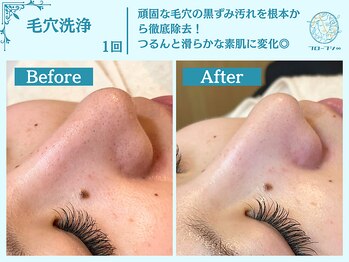 フローフシ∞/【毛穴洗浄】毛穴の黒ずみ解消