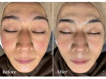 エース(ACE.)/赤み・乾燥を改善しツヤ＆潤い