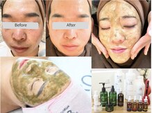【ハーブピーリング】ニキビや毛穴の開きに◎メンズも大歓迎♪