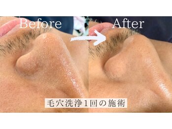 ナチュラル グロウ 木更津(NATURAL GLOW)の写真/【メンズリピートNO.1】頑固な黒ずみ角栓を本格除去！集中ピーリング毛穴ケアはこれで決まり★