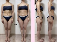 プラスワンビューティテン 新大阪店(Plus One Beauty)/ボディ/ハイパーナイフ/痩身