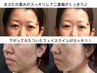NEW♪ソフトダーマ×肌育スキンブースト70分 トライアル ¥11,000