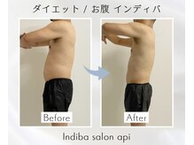 アピ(api)/症例写真【痩身インディバ】