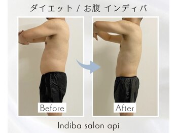 アピ(api)/症例写真【痩身インディバ】