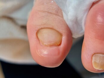 爪切り屋 足楽/剥離爪◆50代女性 (after)