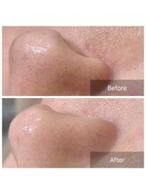 ガレリア エステ 名駅(GALLARIA)/毛穴エクストラクション