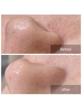 ガレリア エステ 名駅(GALLARIA)/毛穴エクストラクション