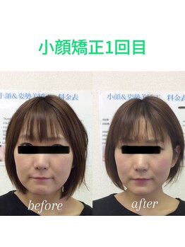 オズ六本木/貴女も圧巻の小顔矯正を是非!