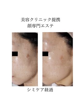 顔専門エステ 印西店/40代シミケア