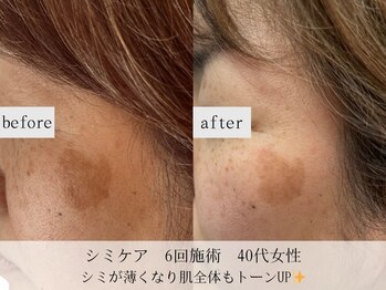 モラン(MO.RAN)/手軽にシミ改善♪