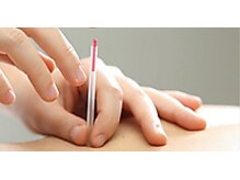 むげん整骨院鍼灸院 近江八幡/美容張鍼でお肌の活性化◎