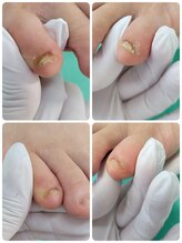 巻き爪補正店 西宮北口店/変形爪