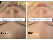 ロージースマイル(Rosy smile)/【韓国肌管理★　セラピール　】
