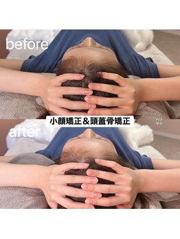 ハリサク/初回施術