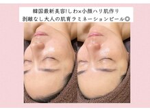 小顔×ハリ肌作り◎韓国最新美容剥離なし肌を育てるピーリング!