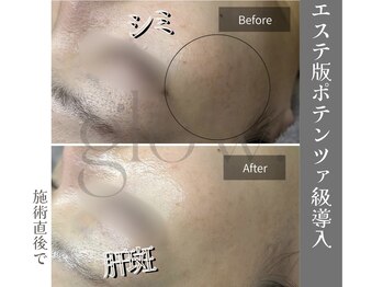 グロウ(glow.)/産後出るシミケア