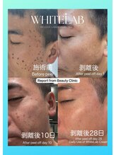 みや美/ホワイトラボ◆施術経過(^^)