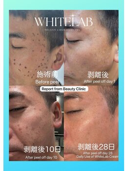 みや美/ホワイトラボ◆施術経過(^^)