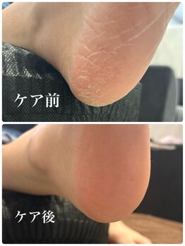 ネロリ(Neroli)/ガサガサかかとがフワフワに!