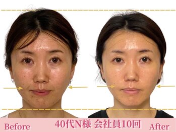 アメリイ 百合ヶ丘 新百合ヶ丘(Amerii)/[40代小顔]たるみ韓国女優顔に!