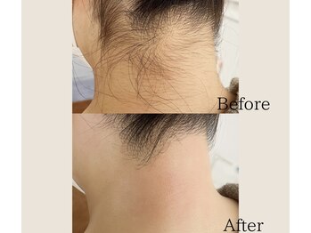 リル(Lill)/うなじワックス脱毛