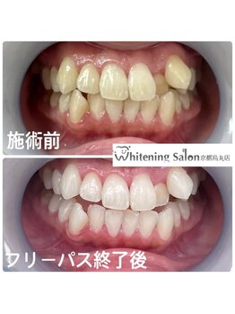 ホワイトニングサロン 京都烏丸店/ホワイトニング施術例