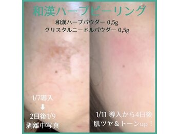 バイオビューティー 神戸本店(Bio Beauty)/ハーブピーリング症例