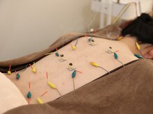 美鍼堂/自律神経を整える鍼