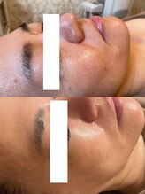 ミツレイ 九条店(MITUREI)/【ハーブピーリング】アフター