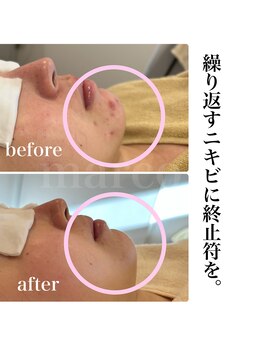 マルコ(marco)/ニキビケア　症例