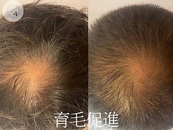LUNEA/《症例》育毛促進