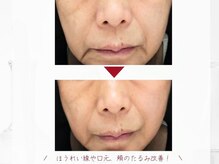 サロンドゥレーヴシエル(Salon de reve Ciel...)の雰囲気（浸透しにくい高分子の美容成分も皮下組織までダイレクトに届く◎）