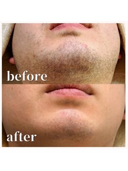 アールエスツネイル(Rs2nail)/男性ヒゲ《IPL脱毛》