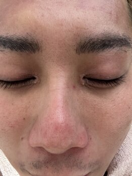 リコリス(Lycoris)/毛穴洗浄