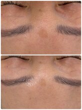 ギャラクシービューティー(galaxy beauty)/ララピールでシミケアも