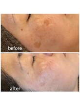 マイルーチェ 可児川合店(MyLuce)/シミ改善