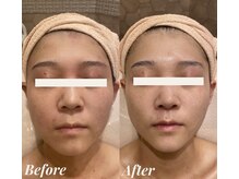 シェリール(Cherir)/ACトリートメント