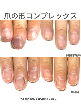 40代/男性/爪の形コンプレックス