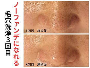 エリン(ERIN)/毛穴徹底洗浄