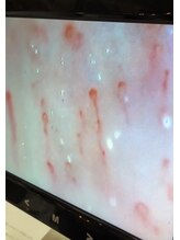 最終形美/毛細血管観察器で血流チェック