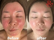 メロー(MELLOW)の雰囲気(赤み・敏感肌にも◎痛みが少ない/剥離無し/ダウンタイム無し)