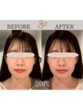 チョコバリ 錦糸町店(chocobari)/小顔×リフトアップ(美容鍼)20代