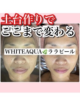 アルムダアクア 天王寺店(Aleumda AQUA)/ハーブピーリング/大阪/天王寺