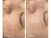 リノン(LINON)/ハーブピーリング 施術回数５回