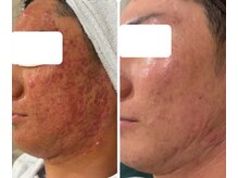 ハクビューティー(HAKU BEAUTY)/赤み/ニキビ/色素ケア/毛穴