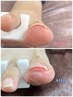 【フット】フット巻爪ケア